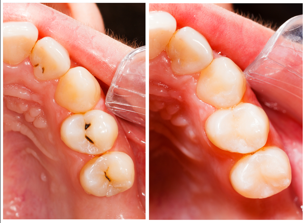 Composite Tooth Colored Fillings