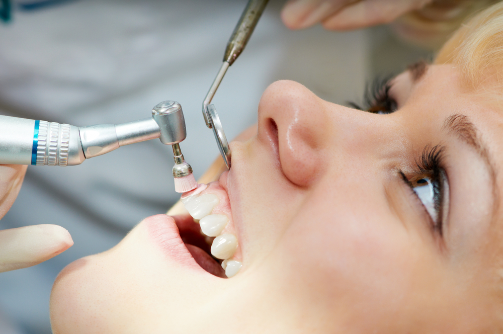 close-up medical dentist procedure of teeth polishing with cleaning from dental deposit and odontolith stock photo