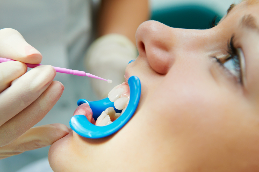 woman with open mouth during dental procedure of teeth protective lacquer covering stock photo