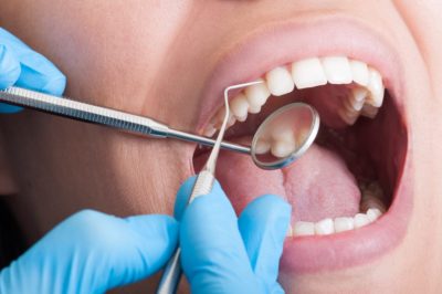 Periodontal Scaling and Root Planning