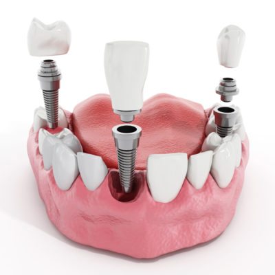 Single Tooth Replacement 3d stock photo