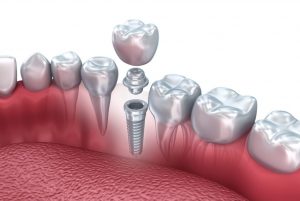 Tooth human implant 3d stock photo