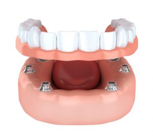 Tooth human implantation, denture (done in 3d rendering) stock photo