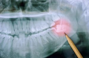 Panoramic x-ray image of teeth stock photo