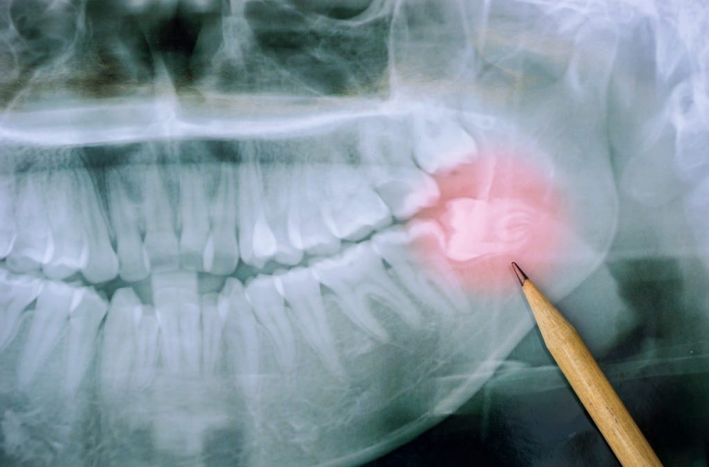 Panoramic x-ray image of teeth stock photo